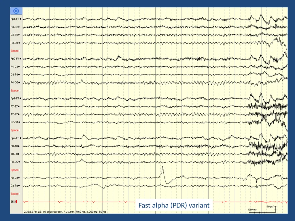 NORMAL ADULT EEG Amar B. Bhatt, MD, FAES Assistant - slide 10 of 66