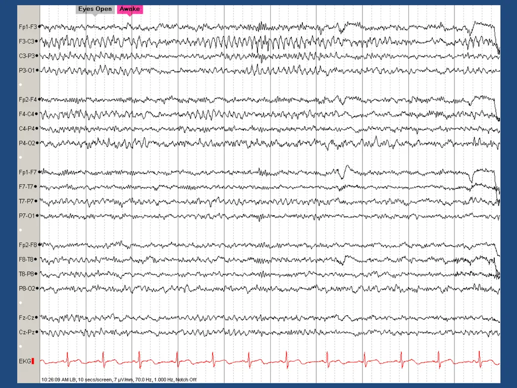 NORMAL ADULT EEG Amar B. Bhatt, MD, FAES Assistant - slide 12 of 66