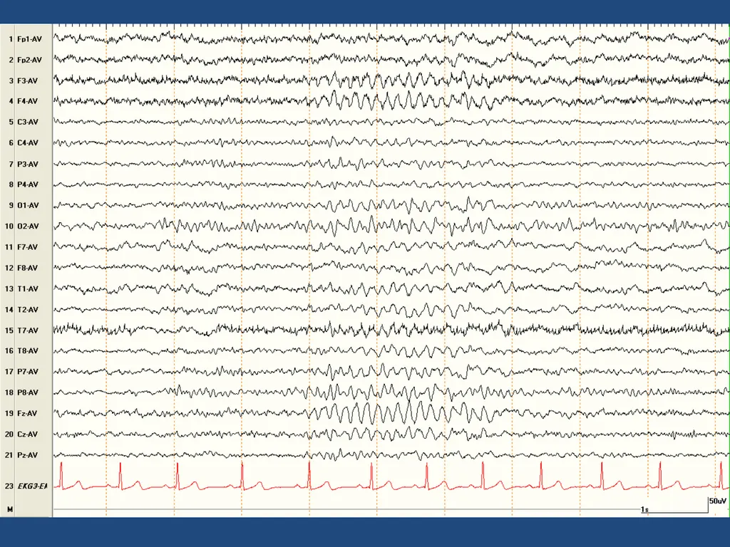 NORMAL ADULT EEG Amar B. Bhatt, MD, FAES Assistant - slide 14 of 66