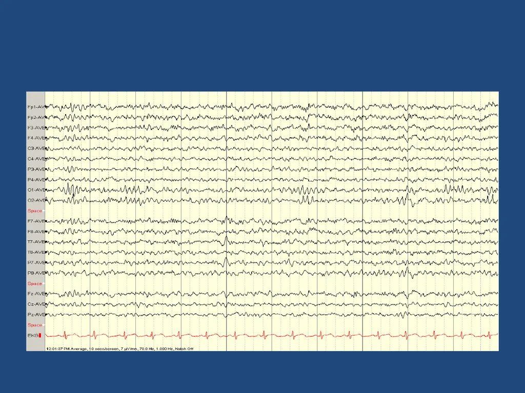 NORMAL ADULT EEG Amar B. Bhatt, MD, FAES Assistant - slide 18 of 66