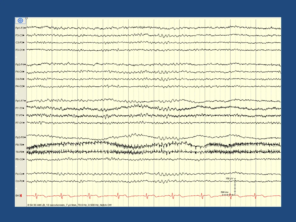 NORMAL ADULT EEG Amar B. Bhatt, MD, FAES Assistant - slide 19 of 66