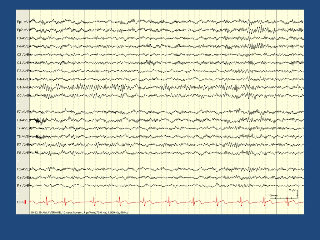 NORMAL ADULT EEG Amar B. Bhatt, MD, FAES Assistant - slide 20 of 66