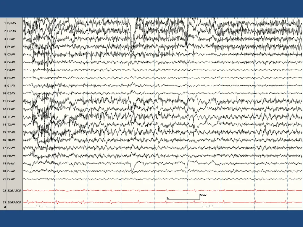 NORMAL ADULT EEG Amar B. Bhatt, MD, FAES Assistant - slide 22 of 66