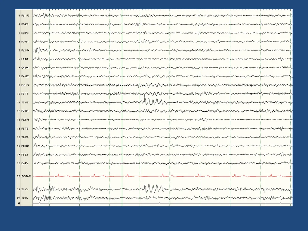 NORMAL ADULT EEG Amar B. Bhatt, MD, FAES Assistant - slide 27 of 66