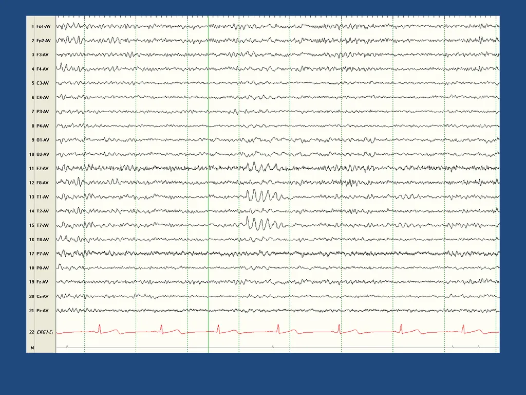 NORMAL ADULT EEG Amar B. Bhatt, MD, FAES Assistant - slide 28 of 66