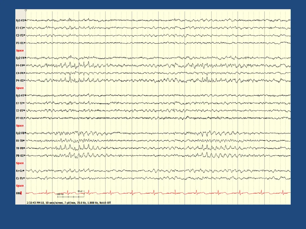 NORMAL ADULT EEG Amar B. Bhatt, MD, FAES Assistant - slide 31 of 66