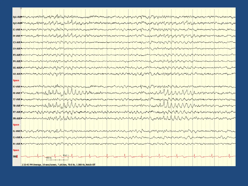NORMAL ADULT EEG Amar B. Bhatt, MD, FAES Assistant - slide 32 of 66