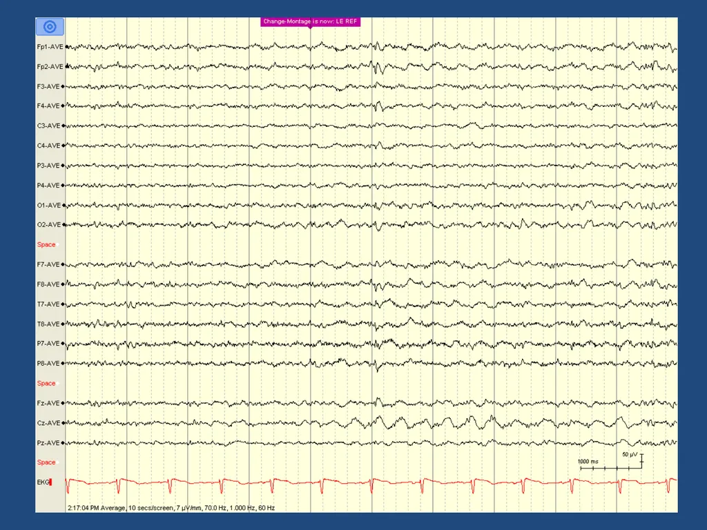 NORMAL ADULT EEG Amar B. Bhatt, MD, FAES Assistant - slide 34 of 66