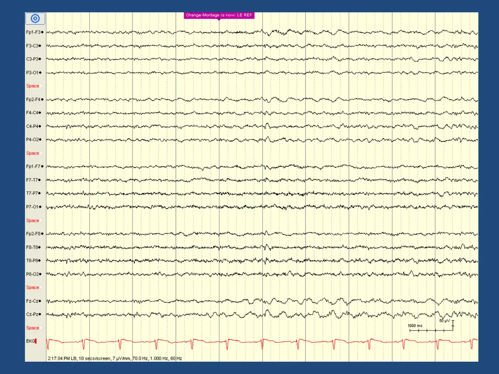 NORMAL ADULT EEG Amar B. Bhatt, MD, FAES Assistant - slide 35 of 66