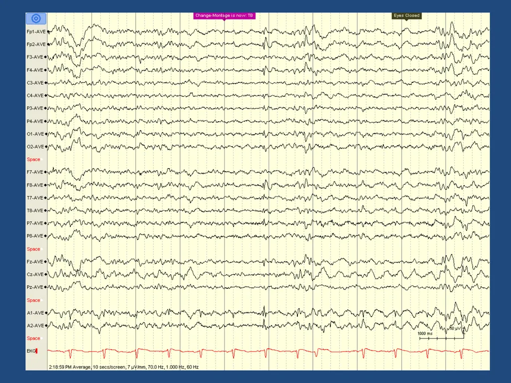 NORMAL ADULT EEG Amar B. Bhatt, MD, FAES Assistant - slide 36 of 66