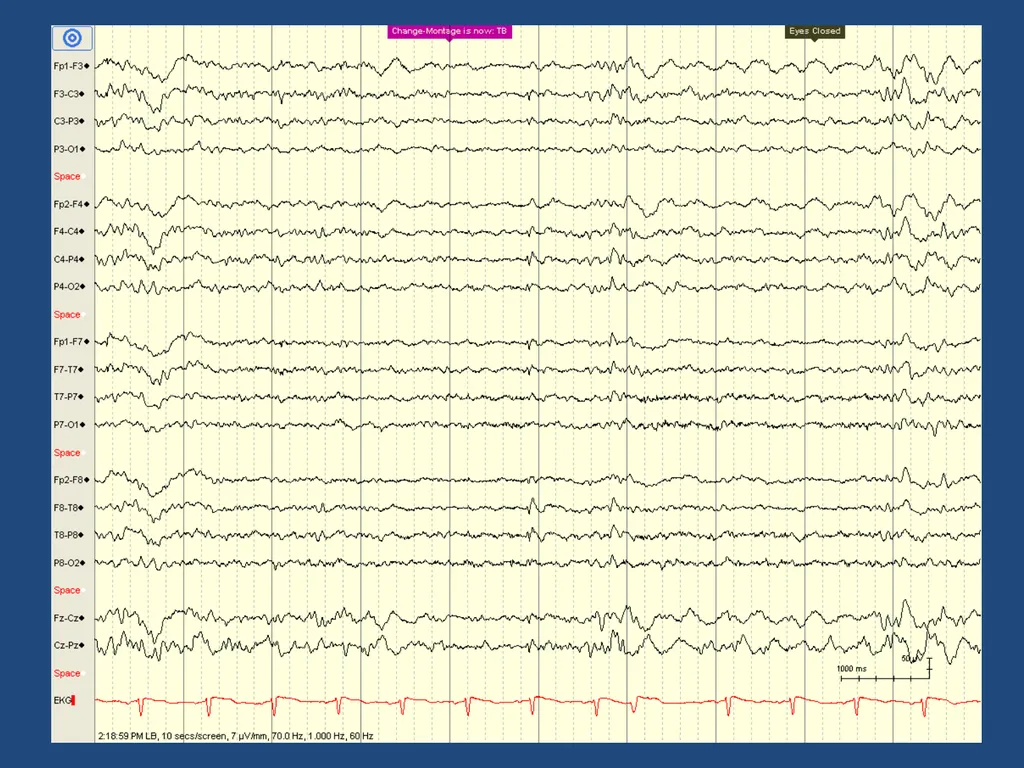 NORMAL ADULT EEG Amar B. Bhatt, MD, FAES Assistant - slide 37 of 66