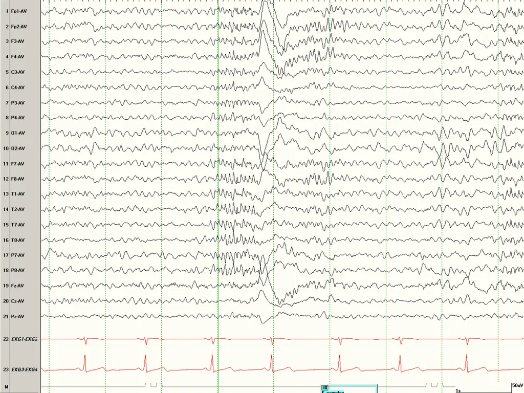 NORMAL ADULT EEG Amar B. Bhatt, MD, FAES Assistant - slide 39 of 66