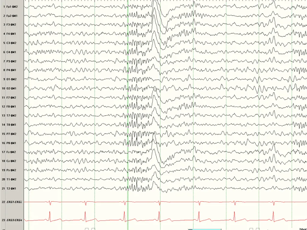 NORMAL ADULT EEG Amar B. Bhatt, MD, FAES Assistant - slide 40 of 66