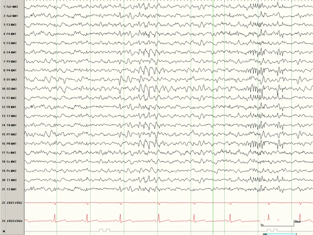 NORMAL ADULT EEG Amar B. Bhatt, MD, FAES Assistant - slide 41 of 66