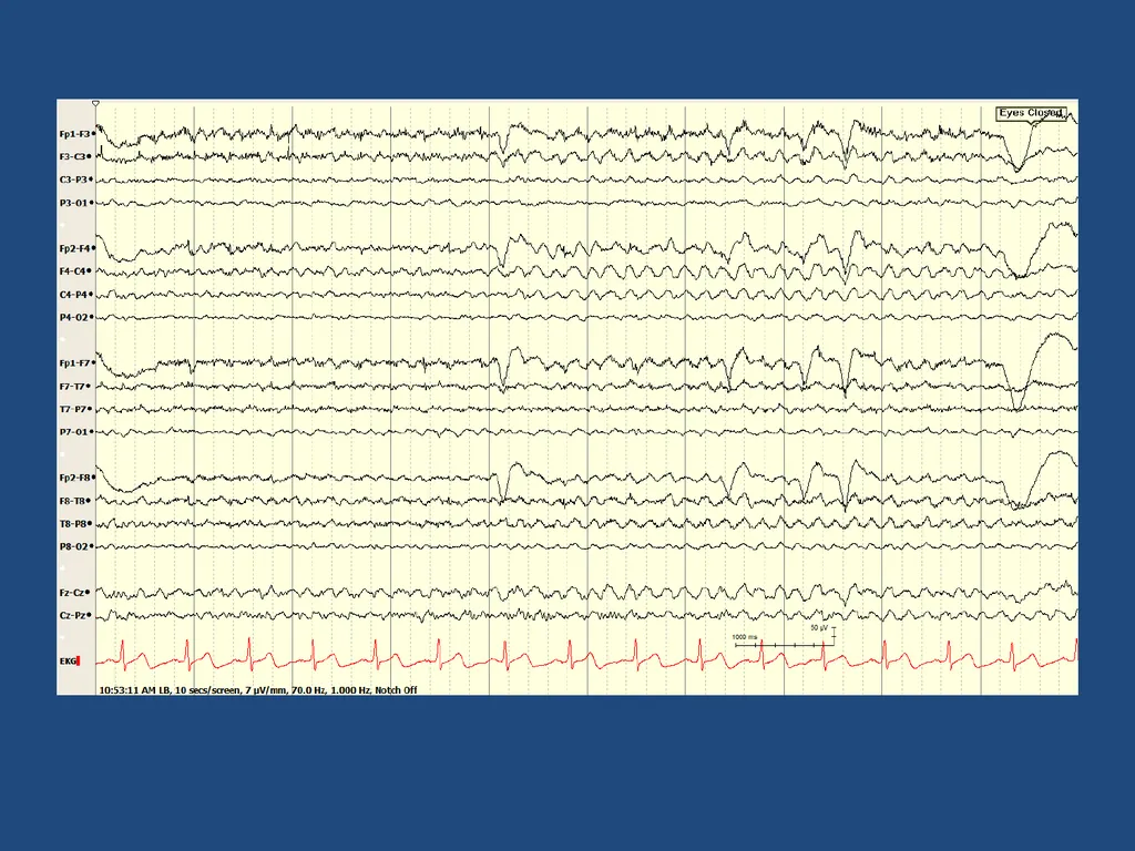 NORMAL ADULT EEG Amar B. Bhatt, MD, FAES Assistant - slide 46 of 66