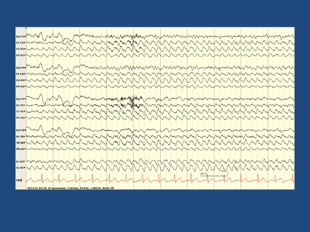 NORMAL ADULT EEG Amar B. Bhatt, MD, FAES Assistant - slide 47 of 66