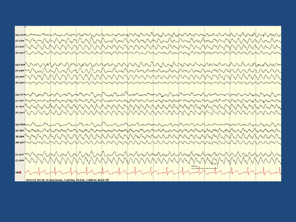 NORMAL ADULT EEG Amar B. Bhatt, MD, FAES Assistant - slide 48 of 66
