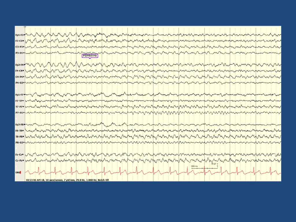 NORMAL ADULT EEG Amar B. Bhatt, MD, FAES Assistant - slide 49 of 66