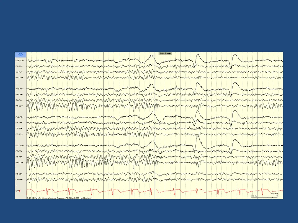 NORMAL ADULT EEG Amar B. Bhatt, MD, FAES Assistant - slide 5 of 66