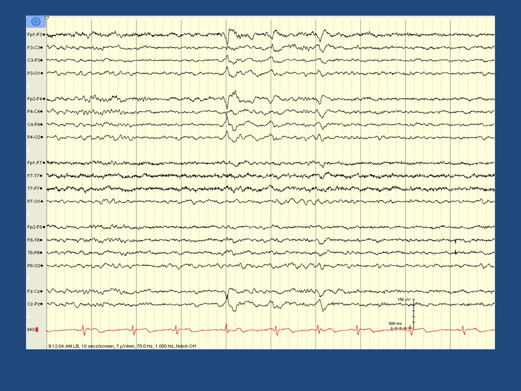 NORMAL ADULT EEG Amar B. Bhatt, MD, FAES Assistant - slide 52 of 66