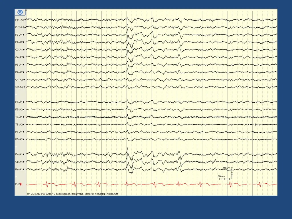 NORMAL ADULT EEG Amar B. Bhatt, MD, FAES Assistant - slide 53 of 66