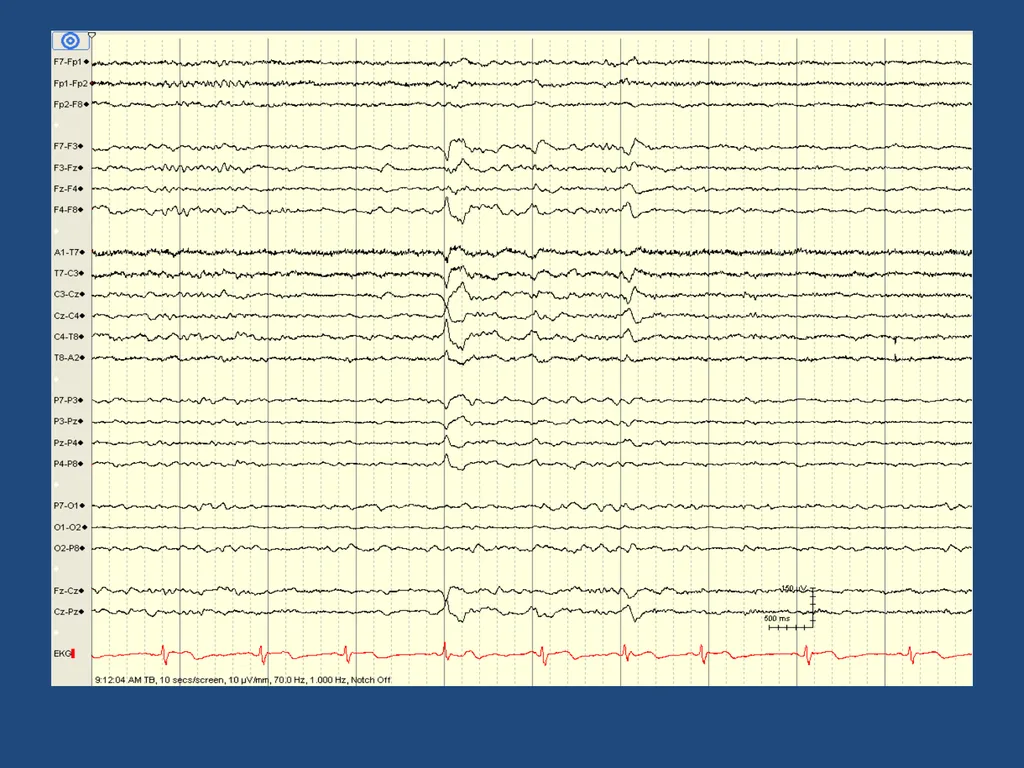 NORMAL ADULT EEG Amar B. Bhatt, MD, FAES Assistant - slide 54 of 66