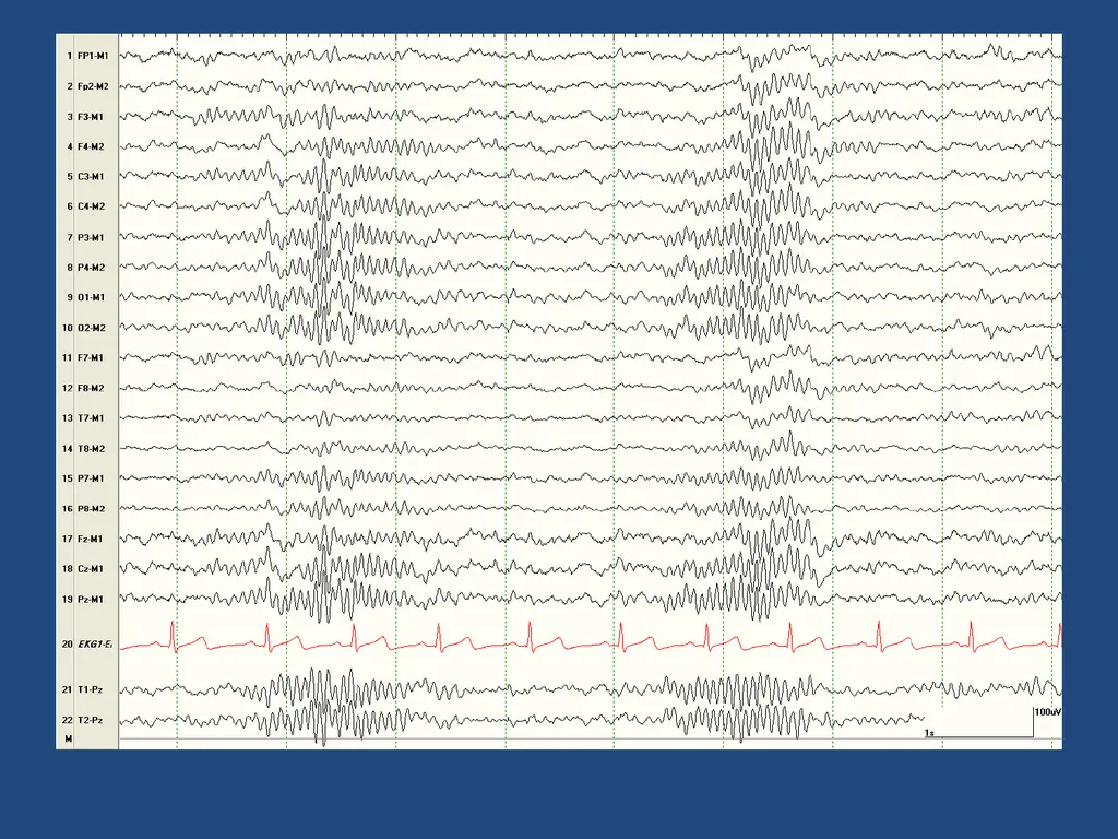 NORMAL ADULT EEG Amar B. Bhatt, MD, FAES Assistant - slide 56 of 66