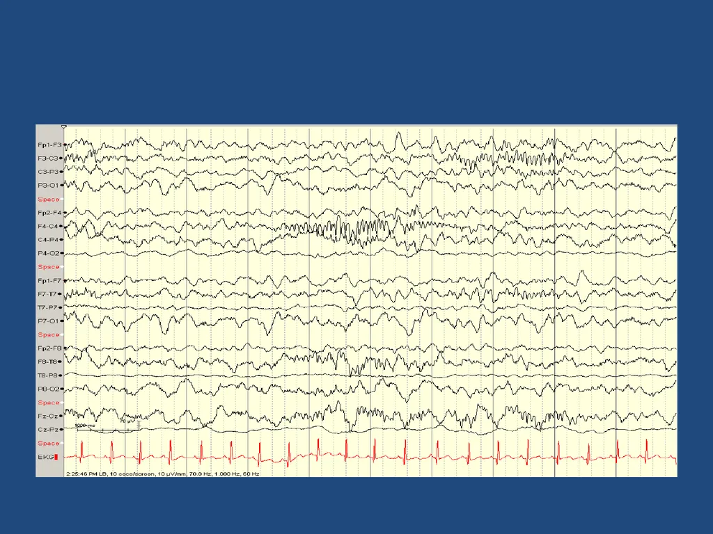 NORMAL ADULT EEG Amar B. Bhatt, MD, FAES Assistant - slide 58 of 66