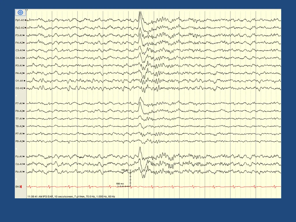 NORMAL ADULT EEG Amar B. Bhatt, MD, FAES Assistant - slide 60 of 66