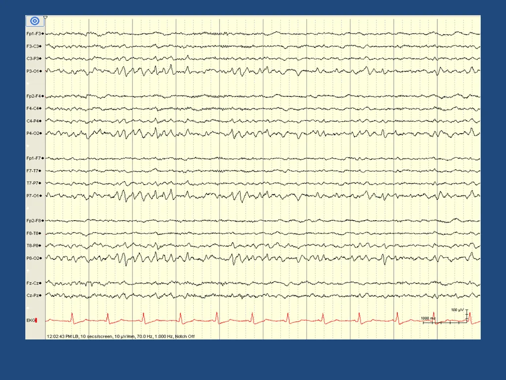 NORMAL ADULT EEG Amar B. Bhatt, MD, FAES Assistant - slide 62 of 66