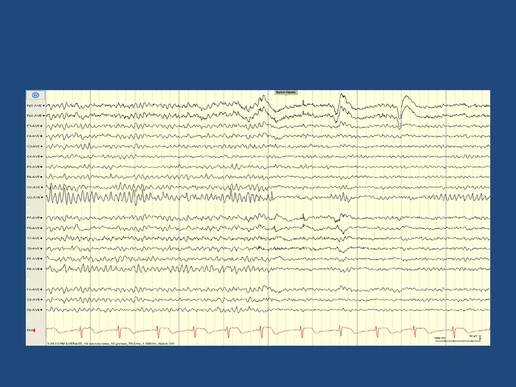 NORMAL ADULT EEG Amar B. Bhatt, MD, FAES Assistant - slide 7 of 66
