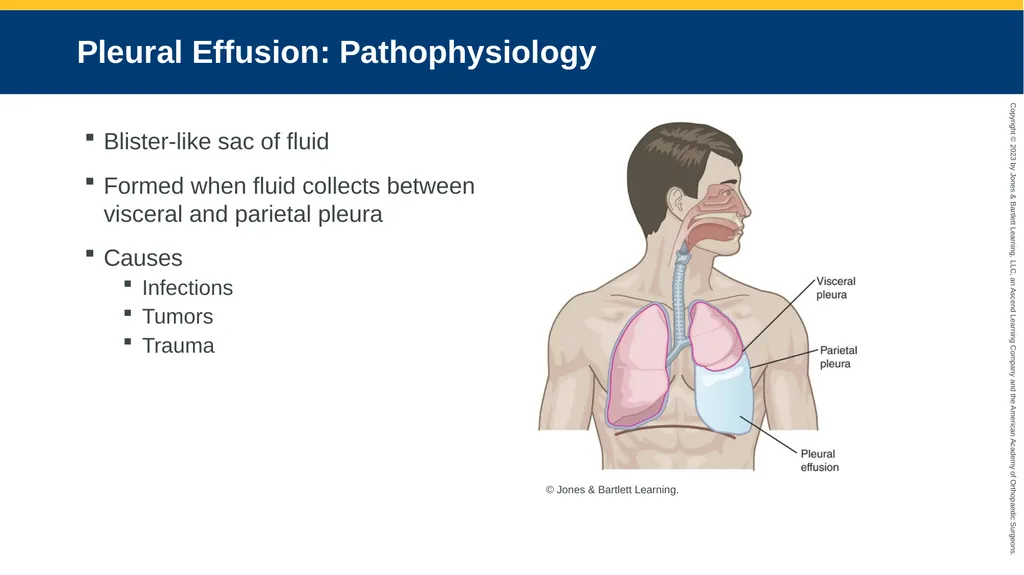 Respiratory Emergencies CHAPTER 17 Introduction - slide 171 of 179