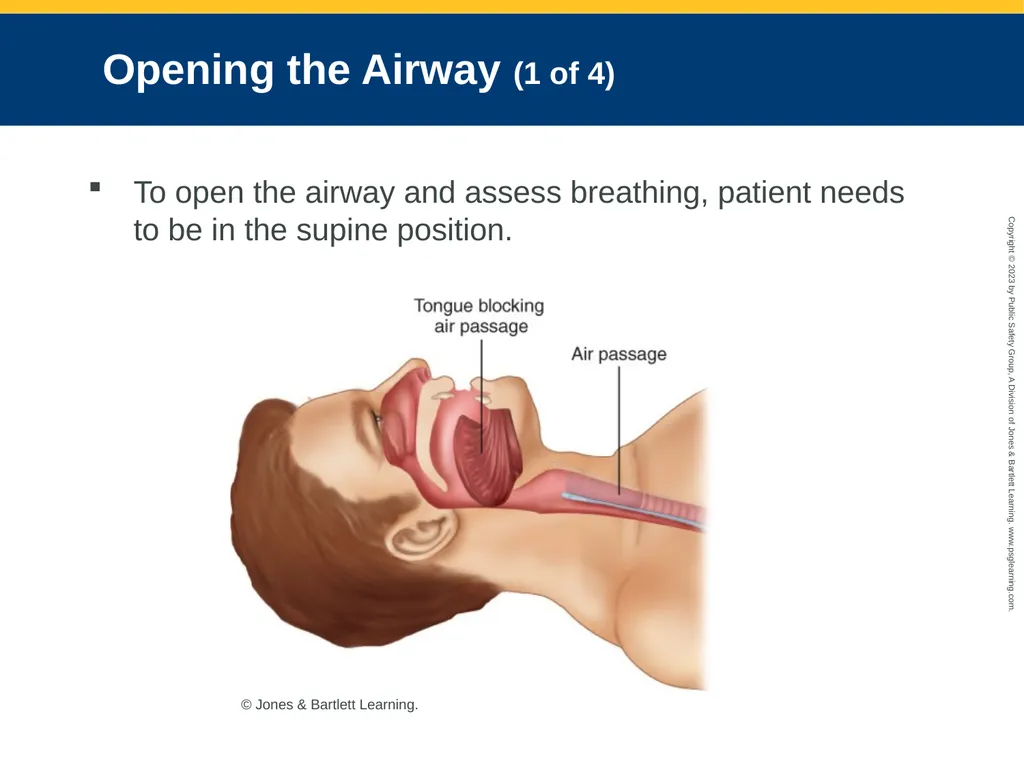 Airway Management CHAPTER 11: Focused Lecture - slide 61 of 139