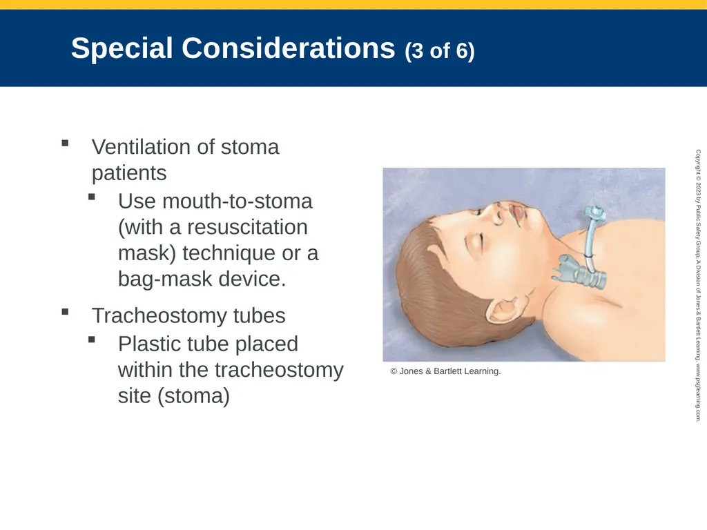 Airway Management CHAPTER 11: Focused Lecture - slide 111 of 139
