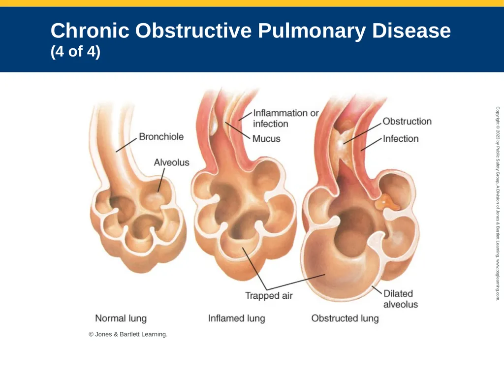 Respiratory Emergencies CHAPTER 17: Focused - slide 29 of 106