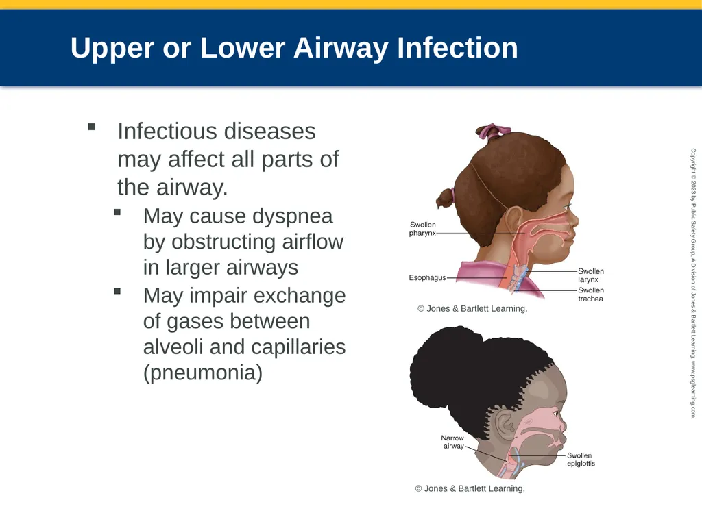Respiratory Emergencies CHAPTER 17: Focused - slide 23 of 106