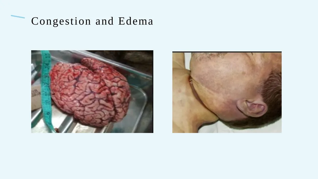 The Forensics of Violent Asphyxia Make sure to - slide 12 of 17