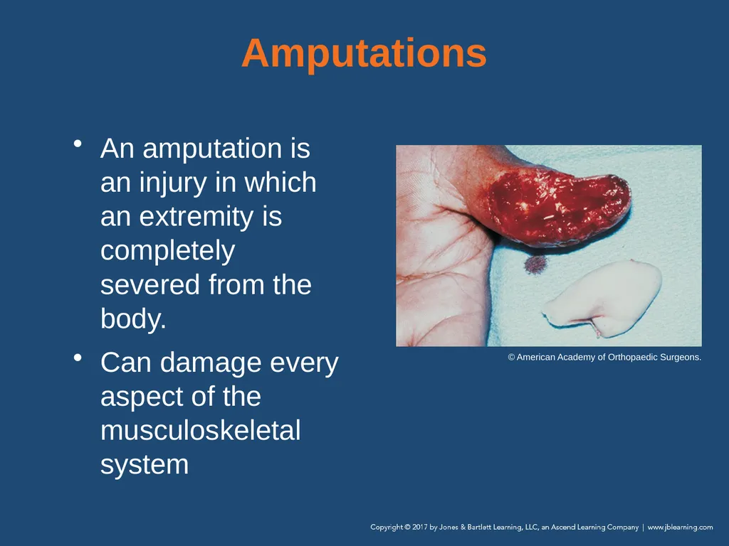 Chapter 31 Orthopaedic Injuries National EMS - slide 38 of 152