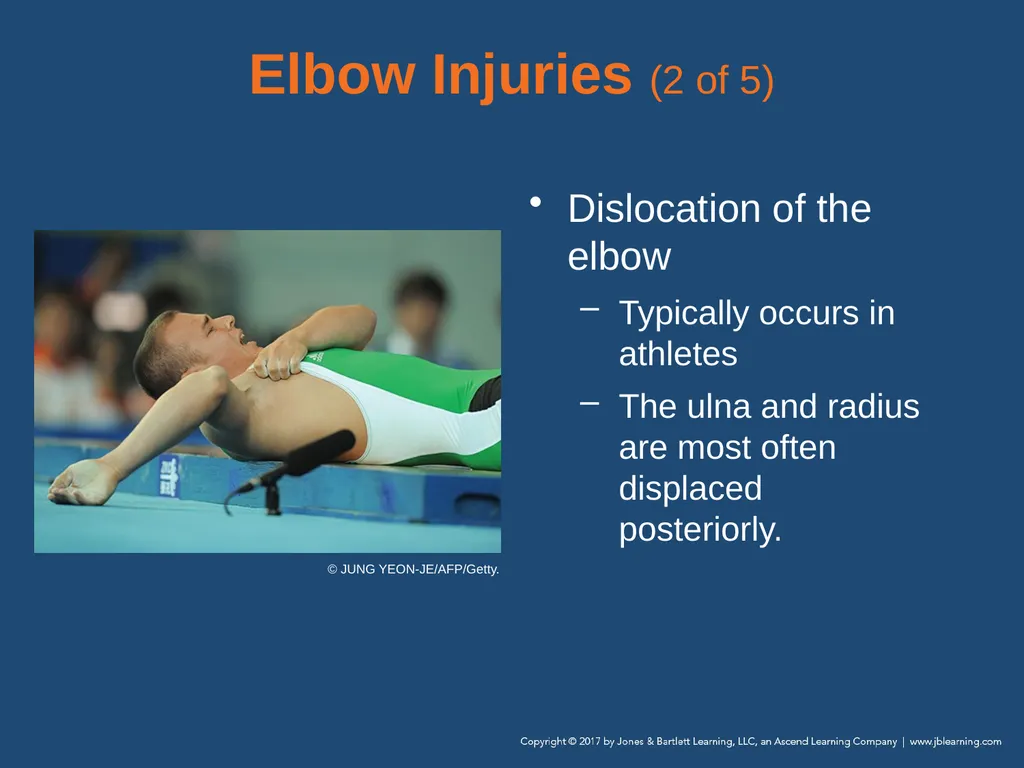 Chapter 31 Orthopaedic Injuries National EMS - slide 79 of 152
