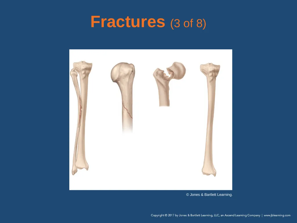 Chapter 31 Orthopaedic Injuries National EMS - slide 27 of 152