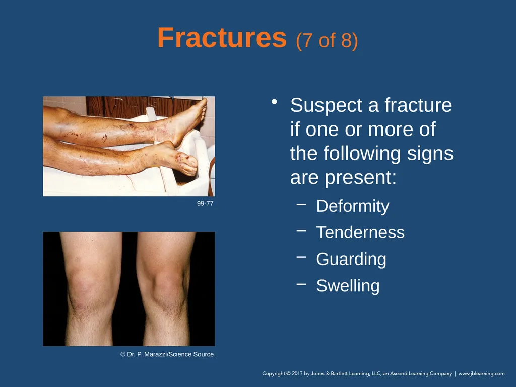 Chapter 31 Orthopaedic Injuries National EMS - slide 31 of 152