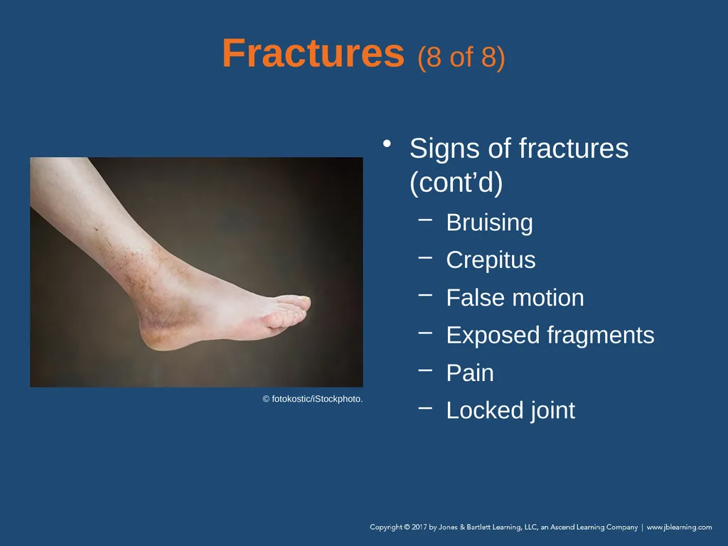 Chapter 31 Orthopaedic Injuries National EMS - slide 32 of 152