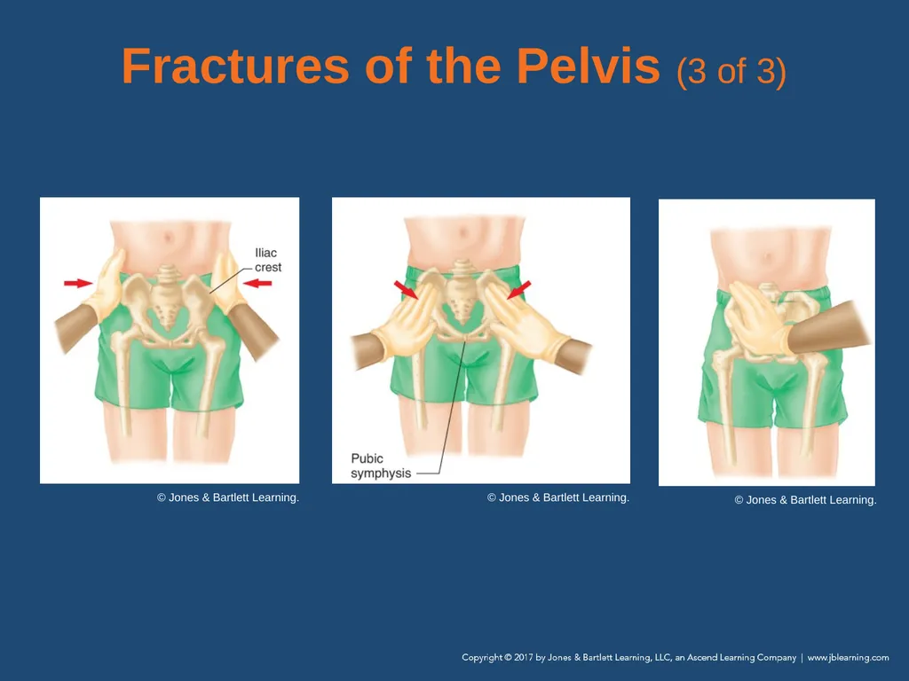 Chapter 31 Orthopaedic Injuries National EMS - slide 87 of 152
