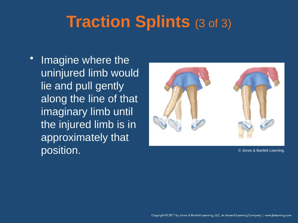 Chapter 31 Orthopaedic Injuries National EMS - slide 69 of 152