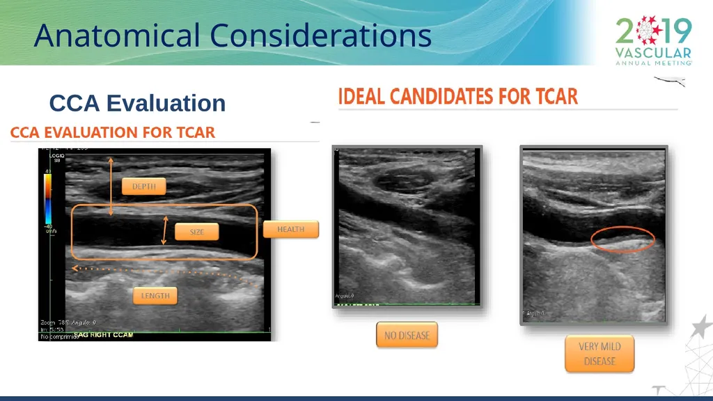 Transcarotid Artery Revascularization Technique : - slide 10 of 18