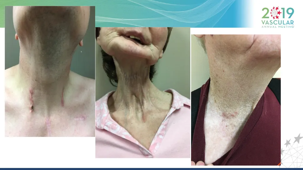 Transcarotid Artery Revascularization Technique : - slide 15 of 18
