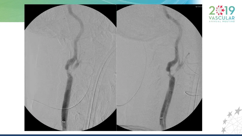 Transcarotid Artery Revascularization Technique : - slide 6 of 18