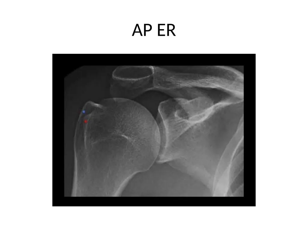 Shoulder Radiography What to consider when - slide 8 of 39