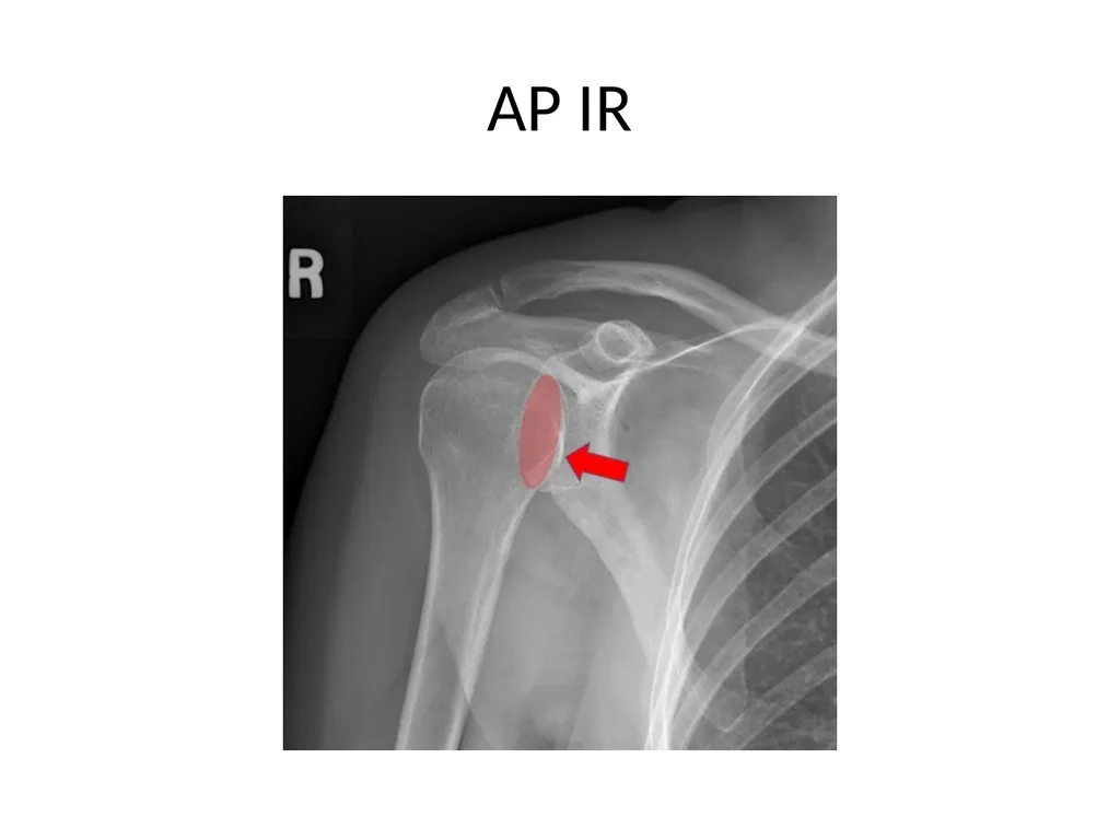 Shoulder Radiography What to consider when - slide 7 of 39