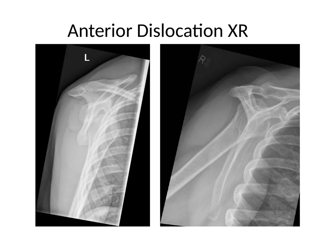 Shoulder Radiography What to consider when - slide 33 of 39